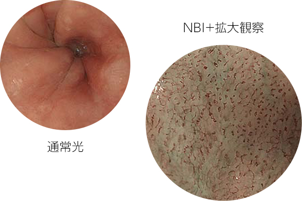4. 拡大内視鏡やNBI観察（狭帯域光観察）による高い診断能力