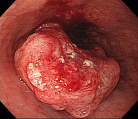 内視鏡写真③　食道癌の食道