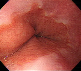 内視鏡写真①　正常の食道