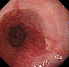 内視鏡写真②　逆流性食道炎の食道